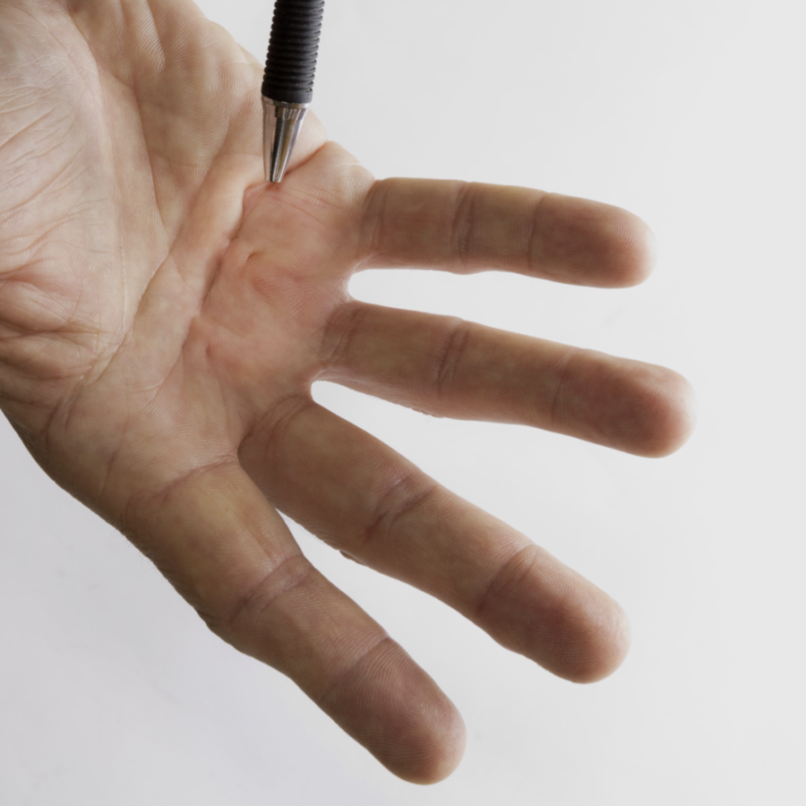 Main affectée par la maladie de Dupuytren